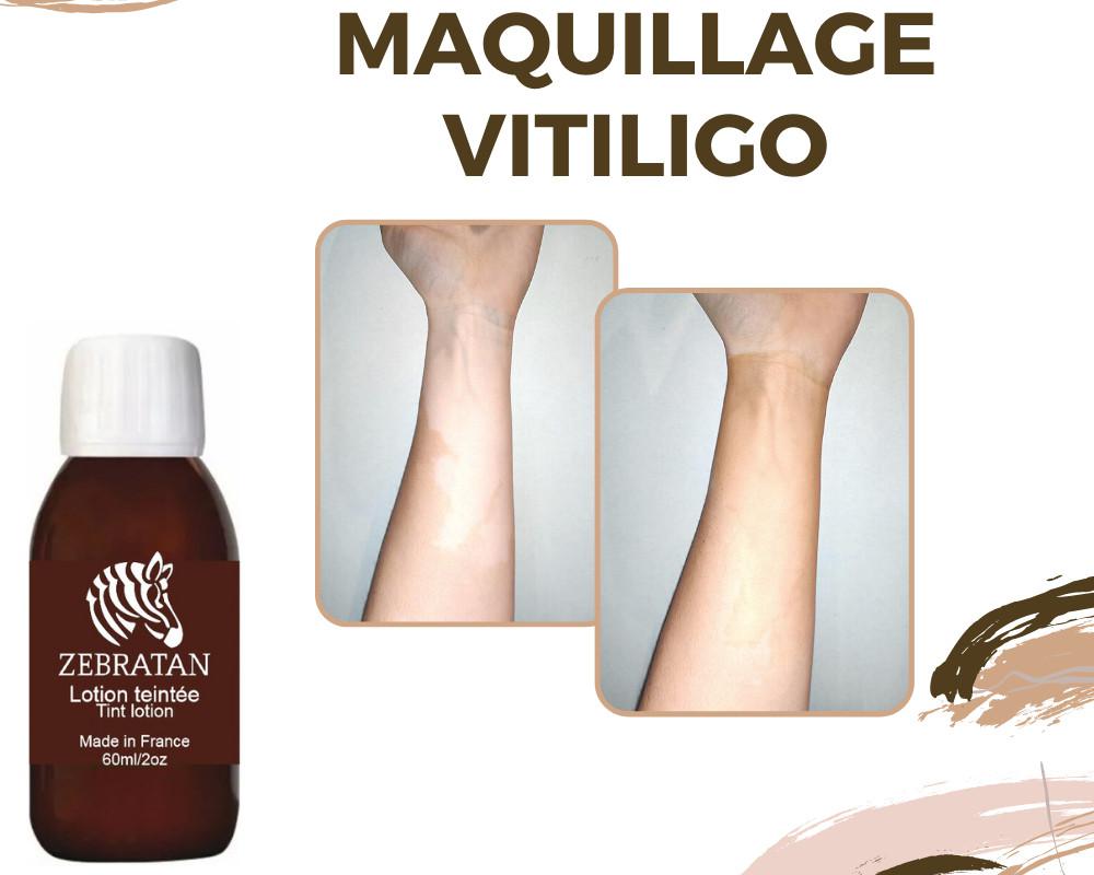 Vitiligo et soleil